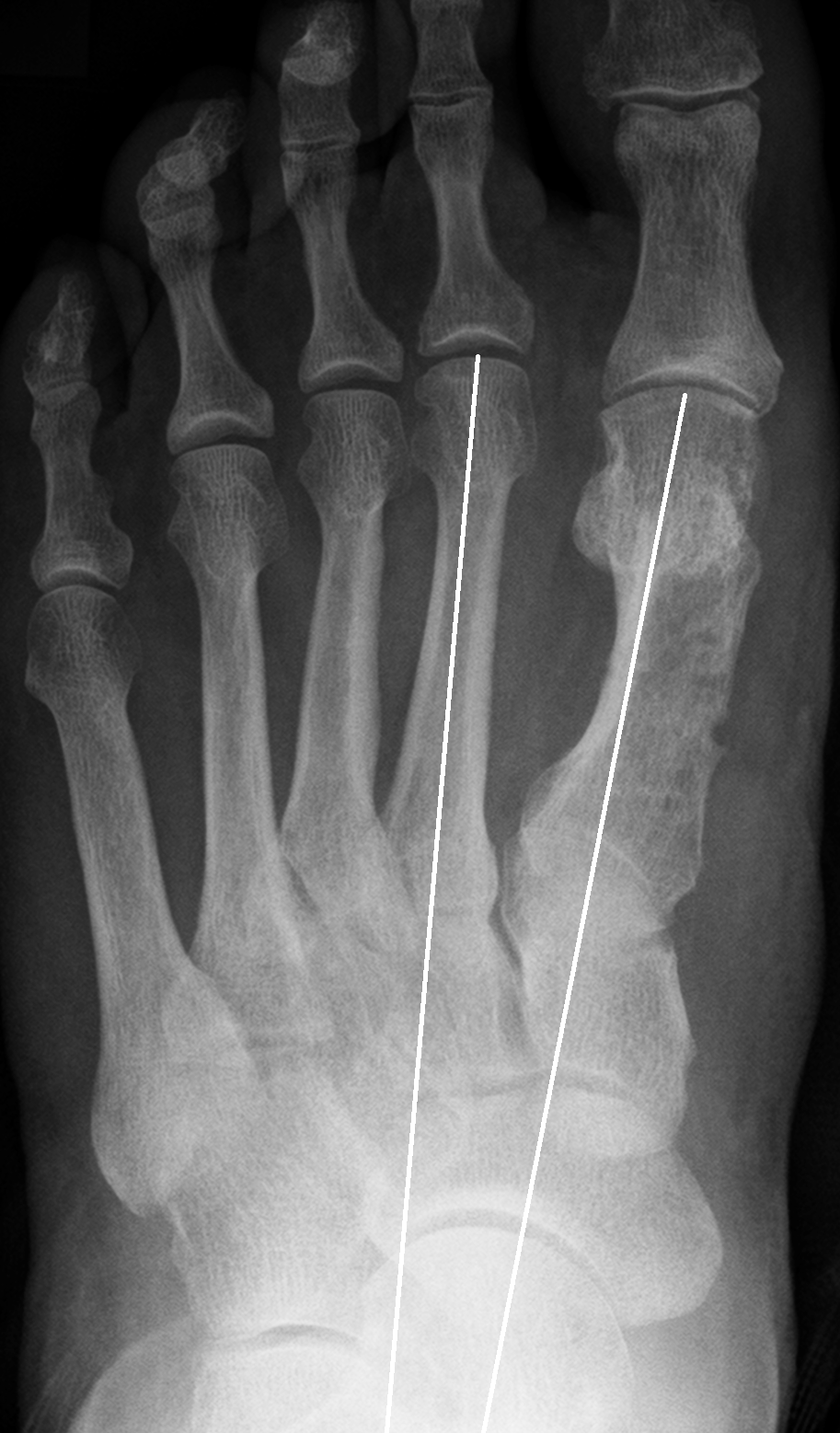 Hallux valgus - korrigiert,
                nach operativer Behandlung Dr. W. Zimmermann