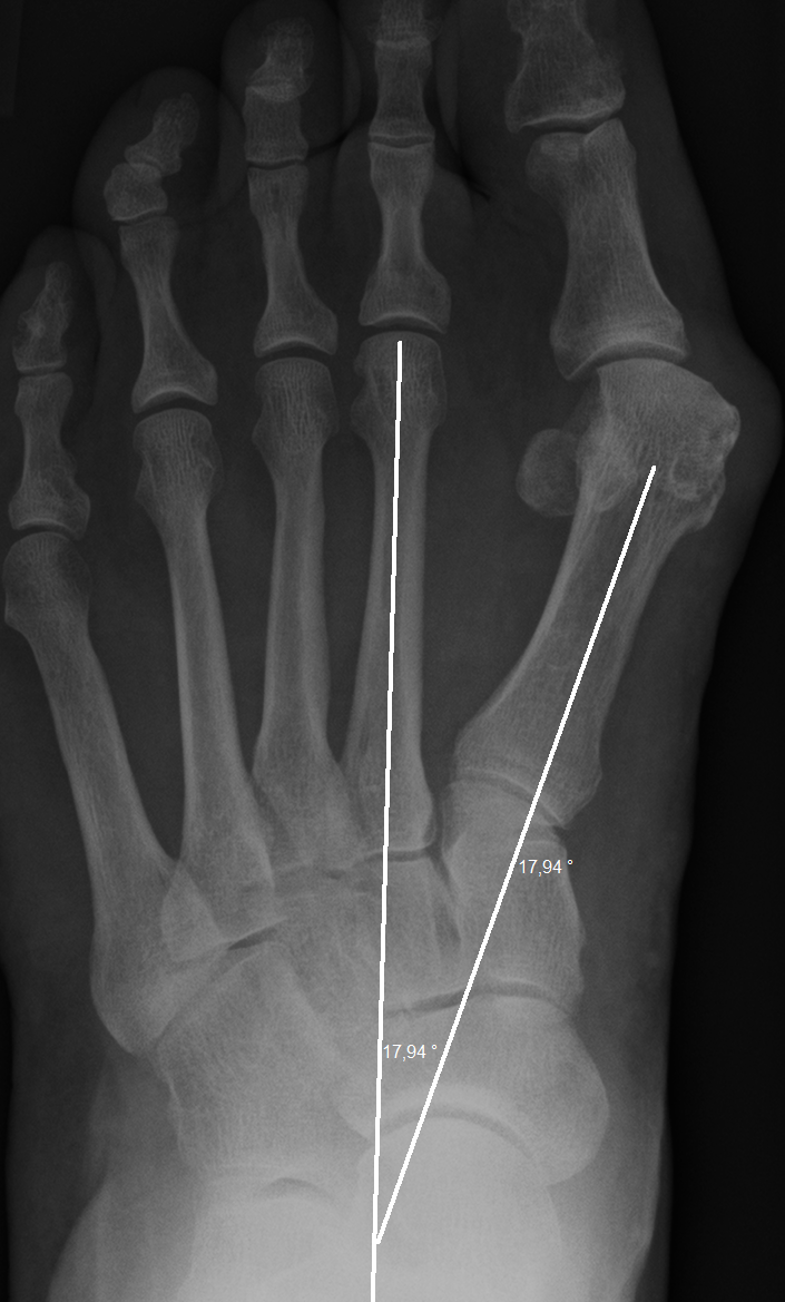 Hallux valgus -
                unkorrigiert, vor operativer Behandlung Dr. W.
                Zimmermann